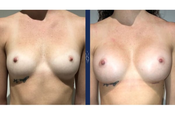 23 year old caucasian woman breast augmentation front - 1