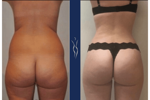 What Exactly Happens During A Brazilian Butt Lift?