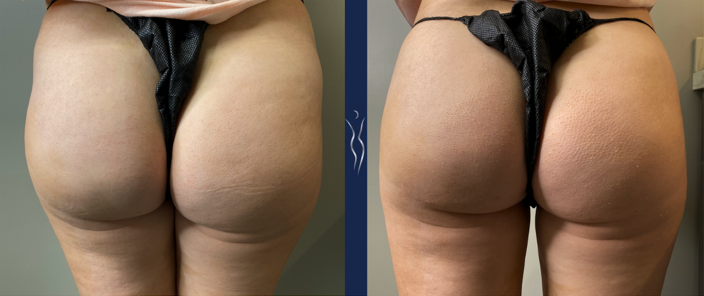 35 year old woman non-surgical buttock augmentation with Sculptra 2