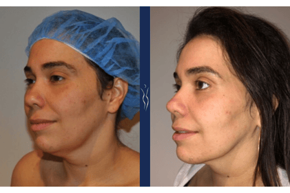 39 year old hispanic lady VASER liposuction and Renuvion neck left oblique