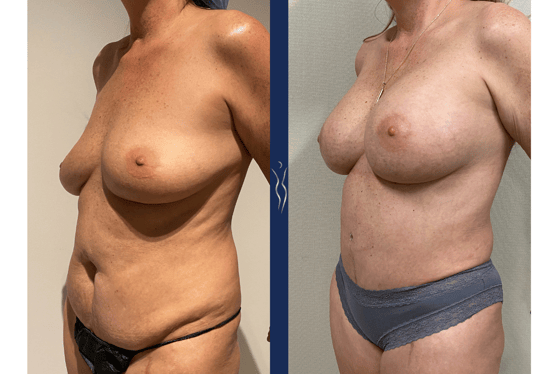 48 year old mommy makeover with tummy tuck and breast augmentation 4 months left oblique