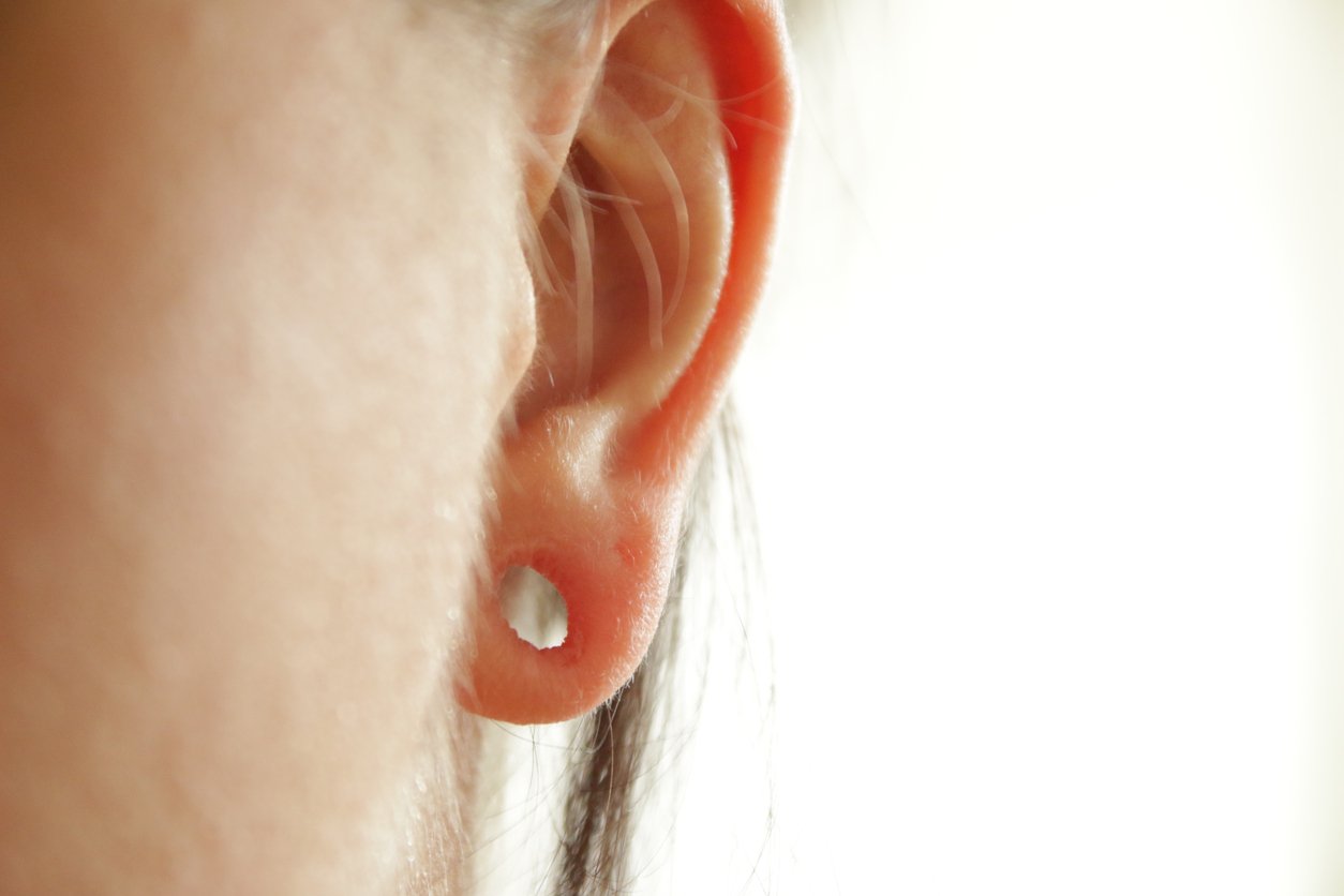 Earlobe Repair - services page - surgical