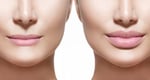 liftingul buzelor este o procedură chirurgicală concepută pentru a ajuta pacienții să obțină un aspect facial general mai plăcut din punct de vedere estetic. Există mai multe tipuri de ascensoare care pot aborda preocupările dumneavoastră individuale. Un lift superior crește plinătatea pentru o buză cu aspect mai voluptuos și vă permite să arătați mai mulți dinți superiori atunci când zâmbiți.
