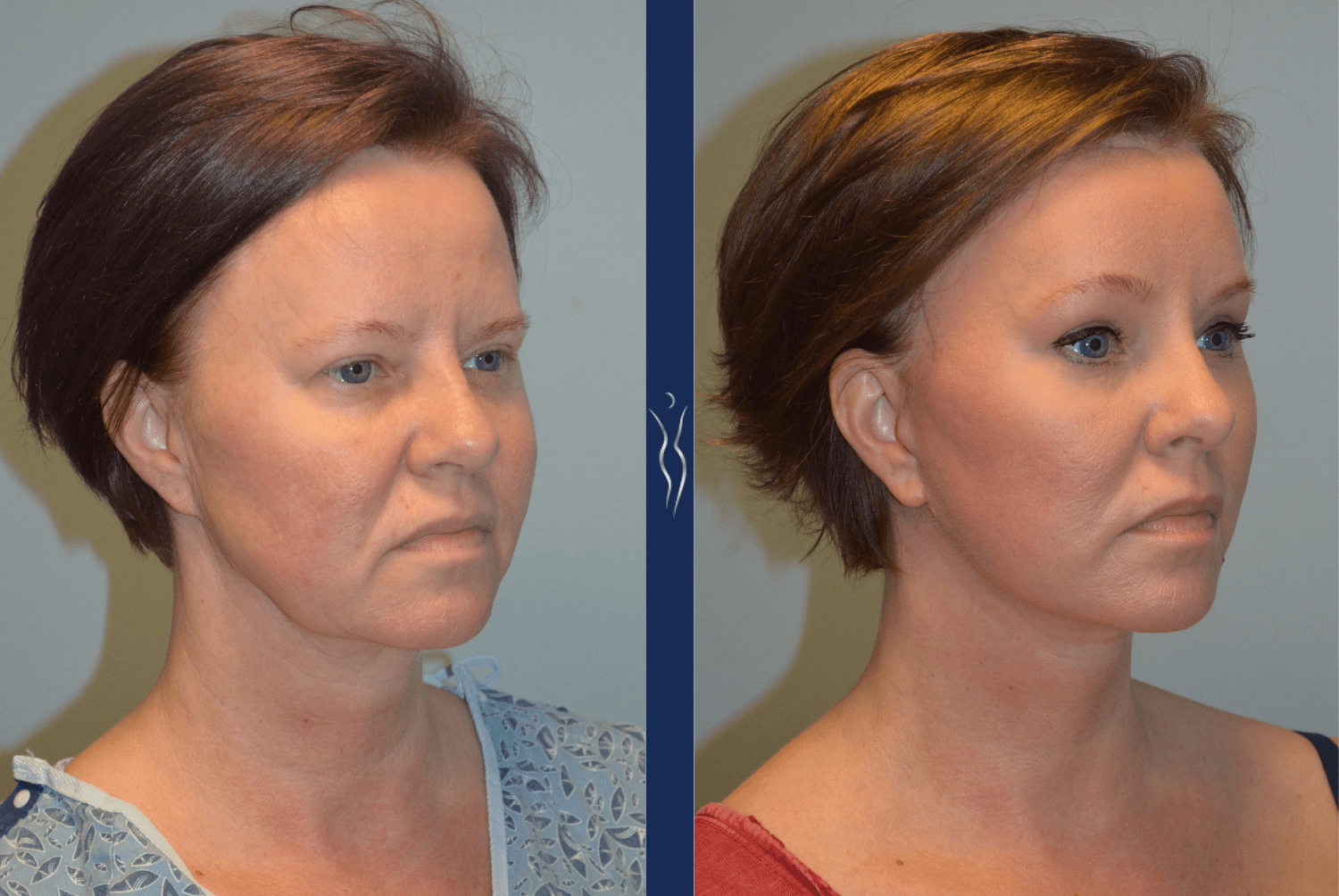 facelift before/after