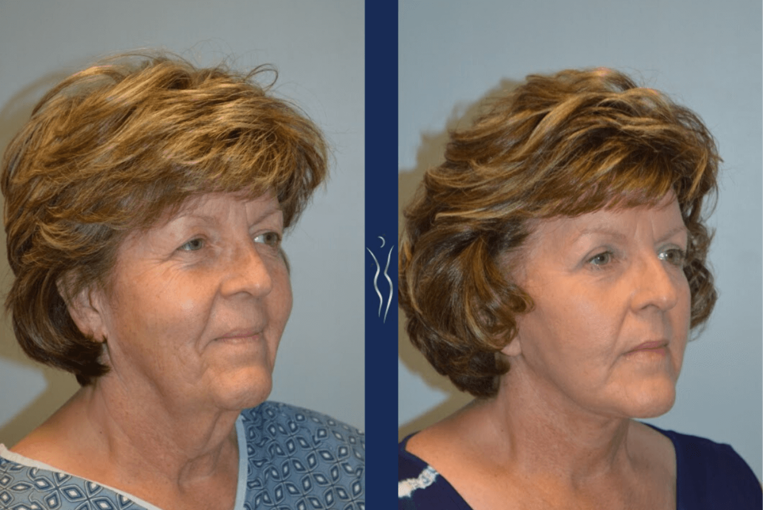 Facelift before/after