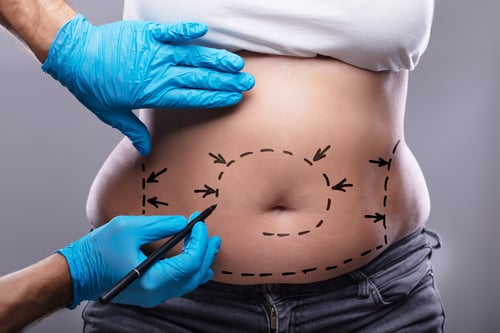 8 Misconceptions About Liposuction