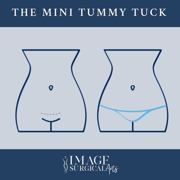 mini tummy tuck