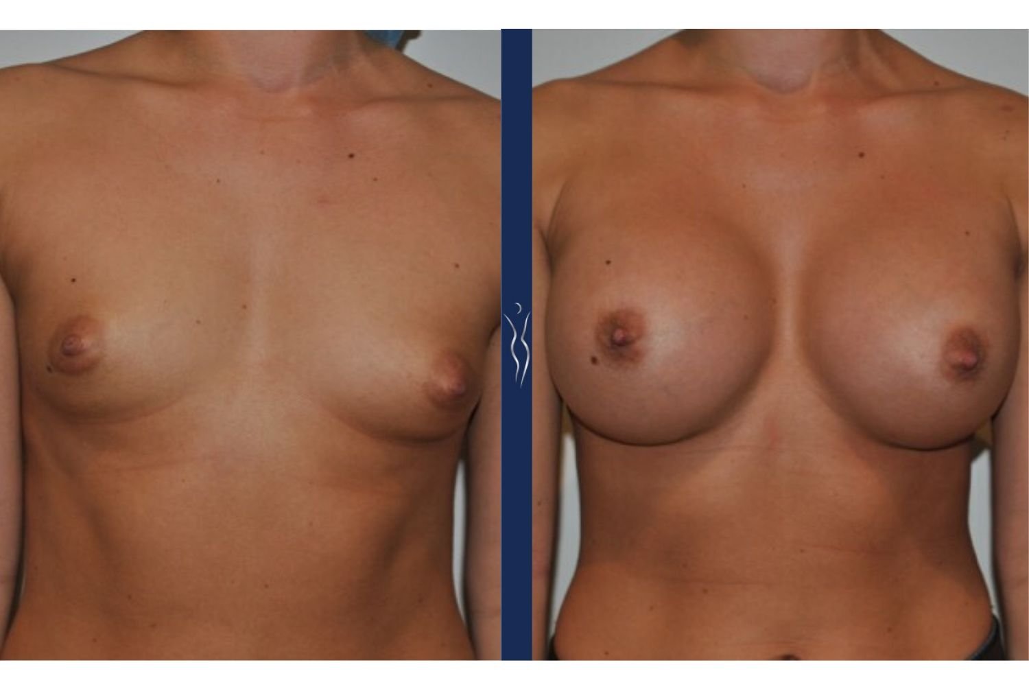 23 year old caucasian woman breast augmentation front