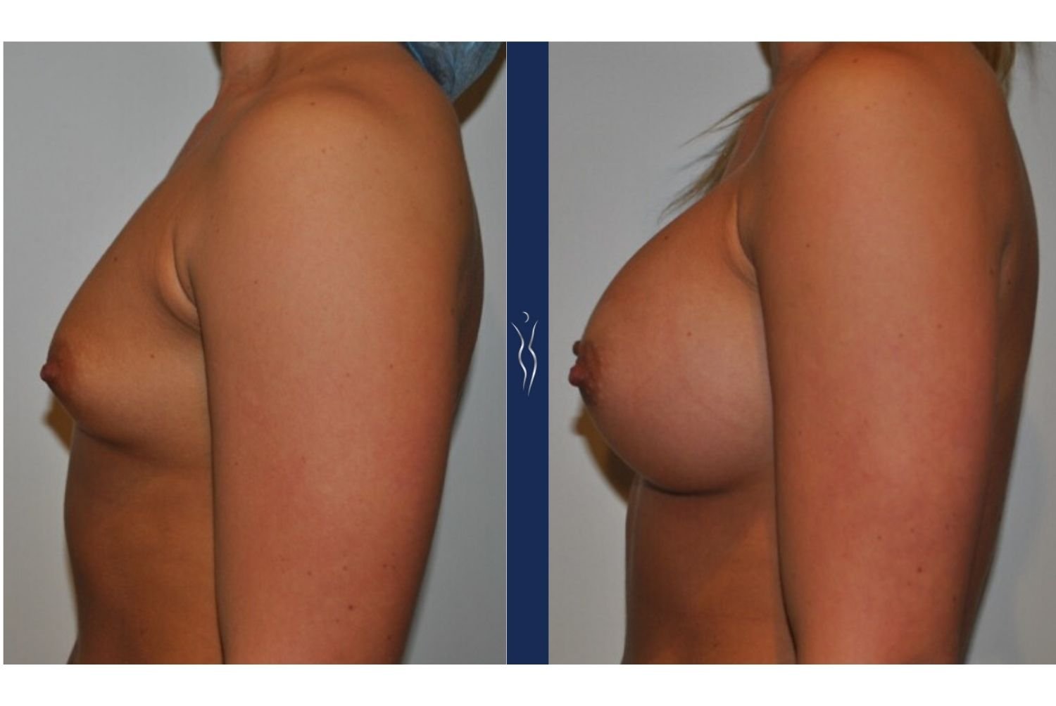 23 year old caucasian woman breast augmentation left lateral