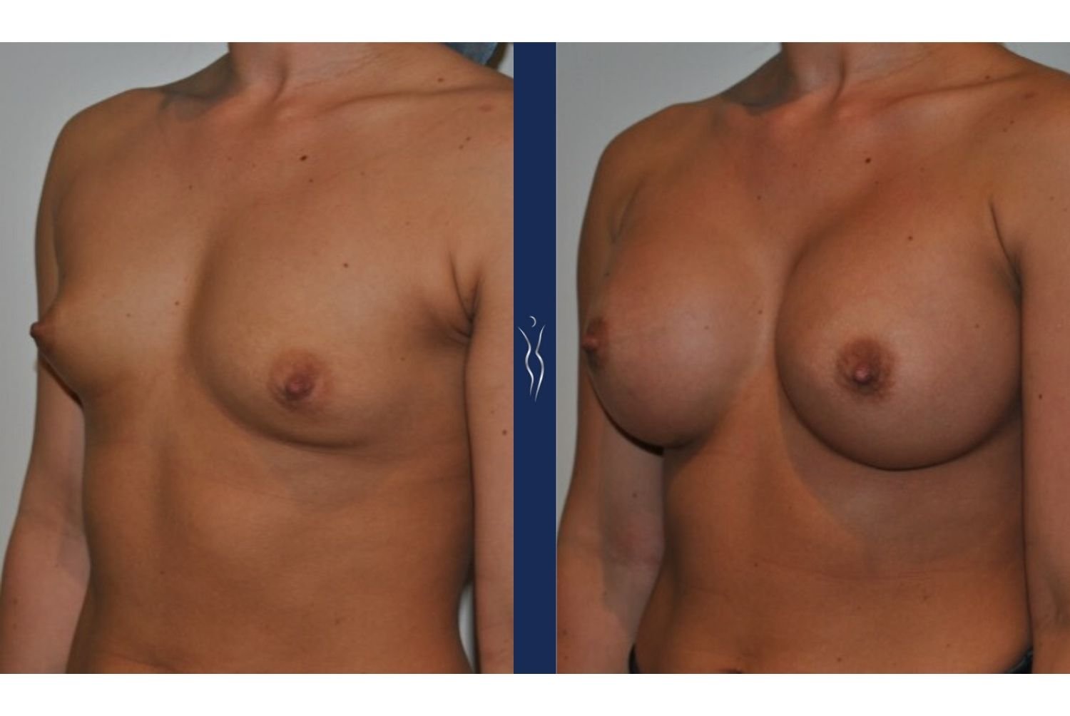 23 year old caucasian woman breast augmentation left oblique