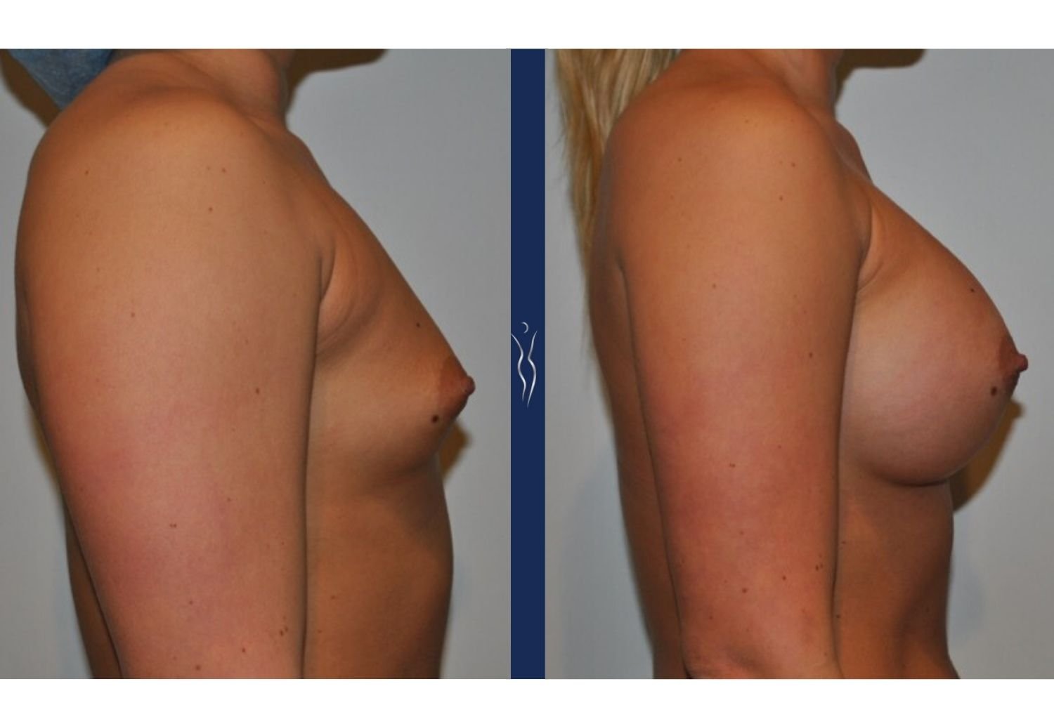 23 year old caucasian woman breast augmentation right lateral