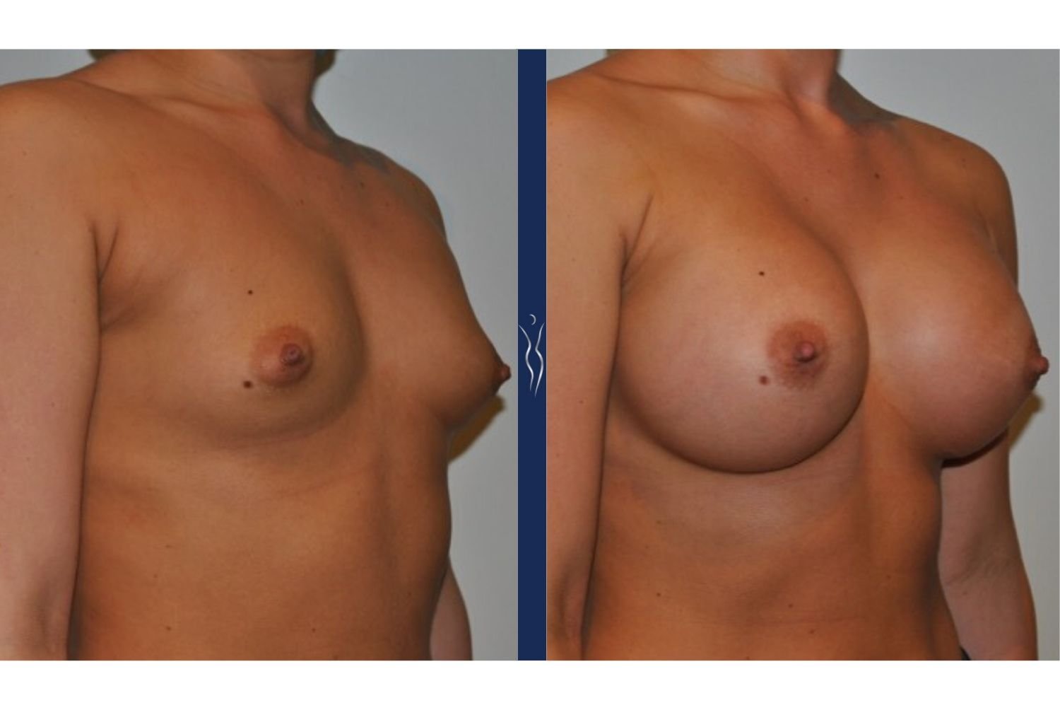 23 year old caucasian woman breast augmentation right oblique