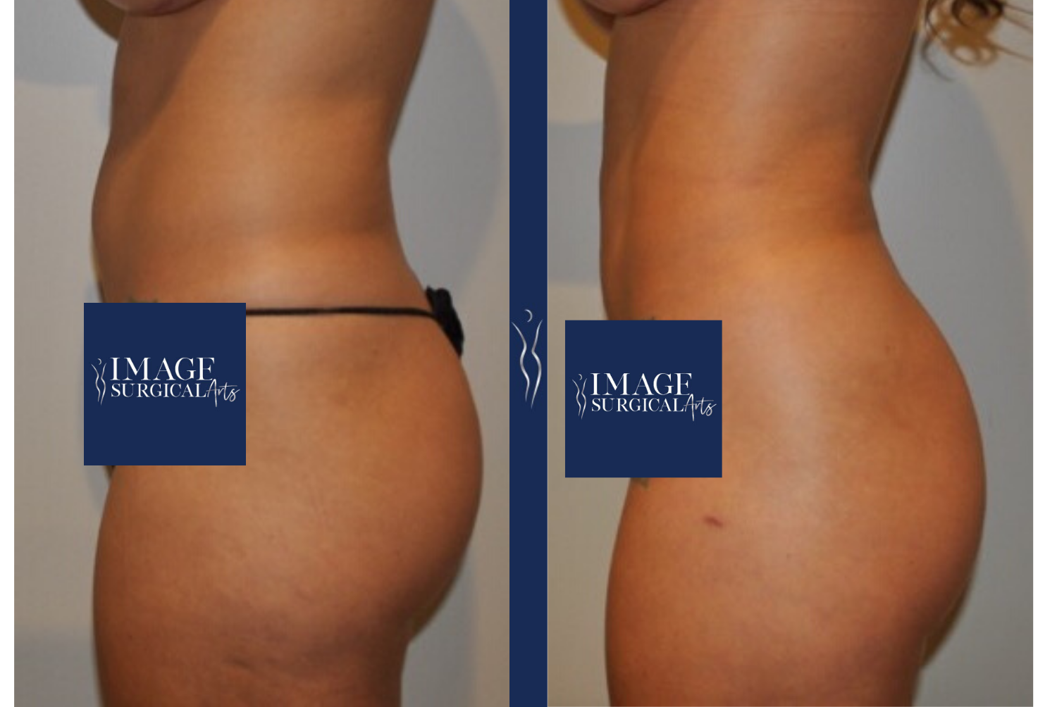 27 year old caucasian lady VASER liposuction and Renuvion with Brazilian Butt Lift left lateral-1