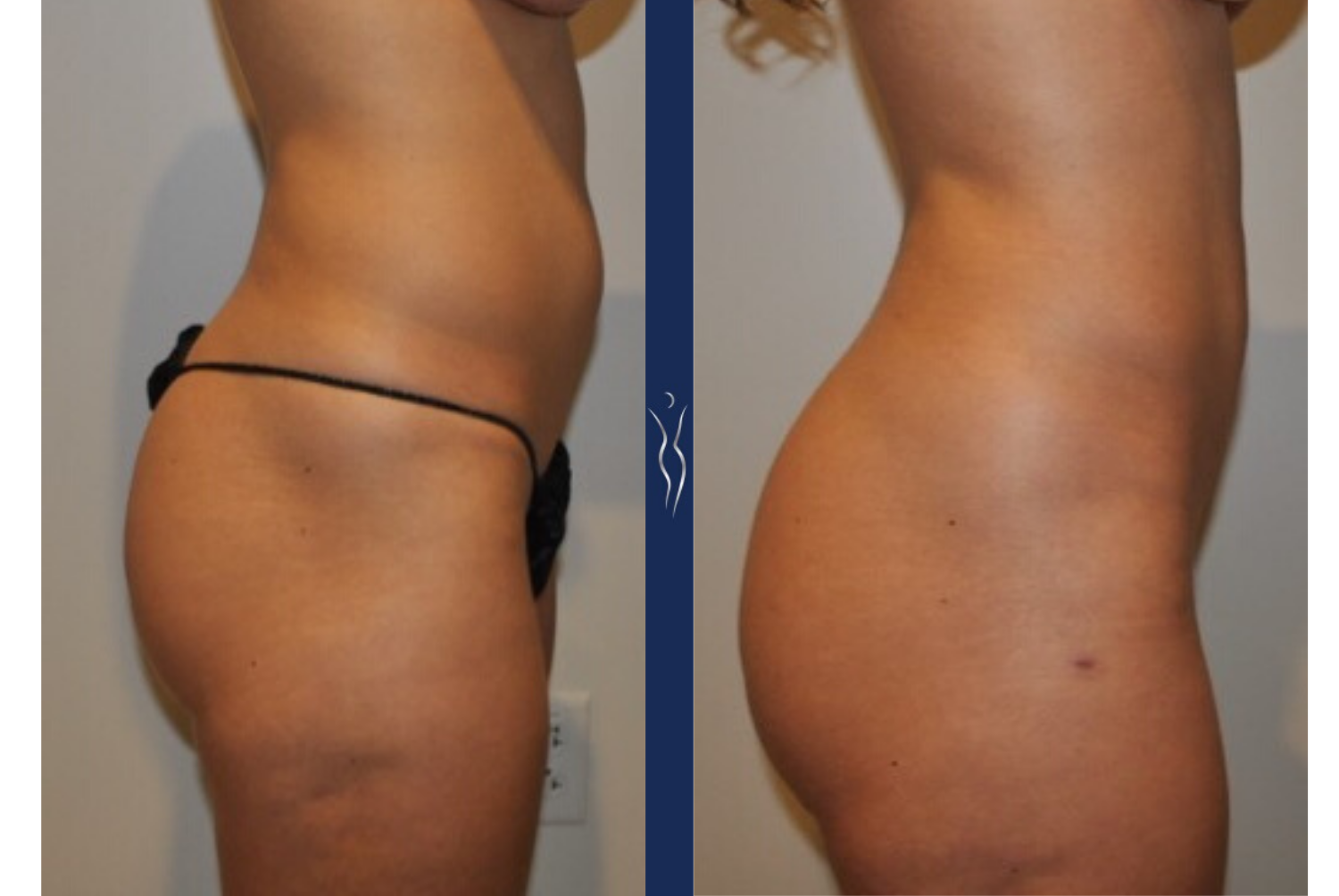 27 year old caucasian lady VASER liposuction and Renuvion with Brazilian Butt Lift right lateral-1
