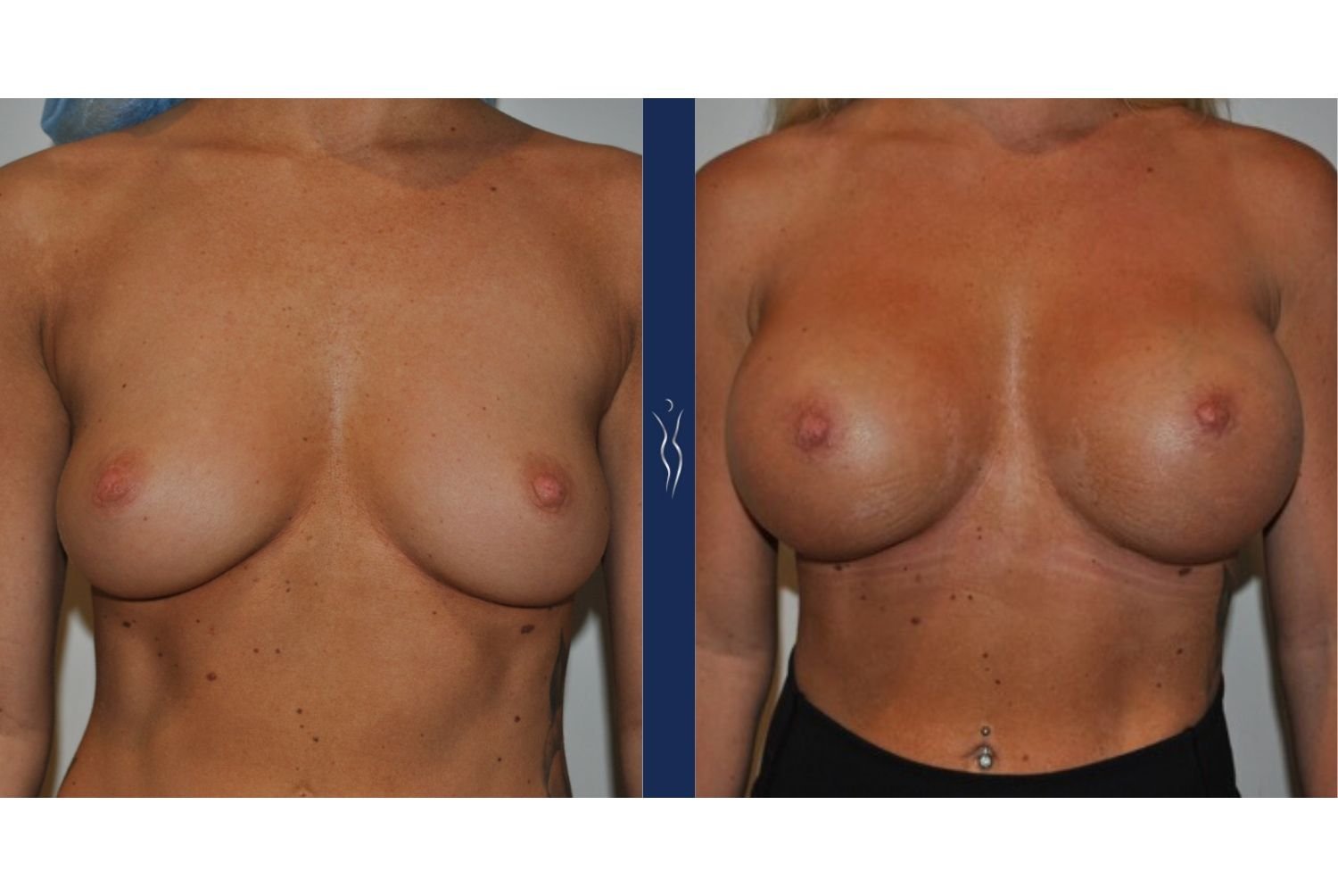 27 year old caucasian woman breast augmentation front - 1