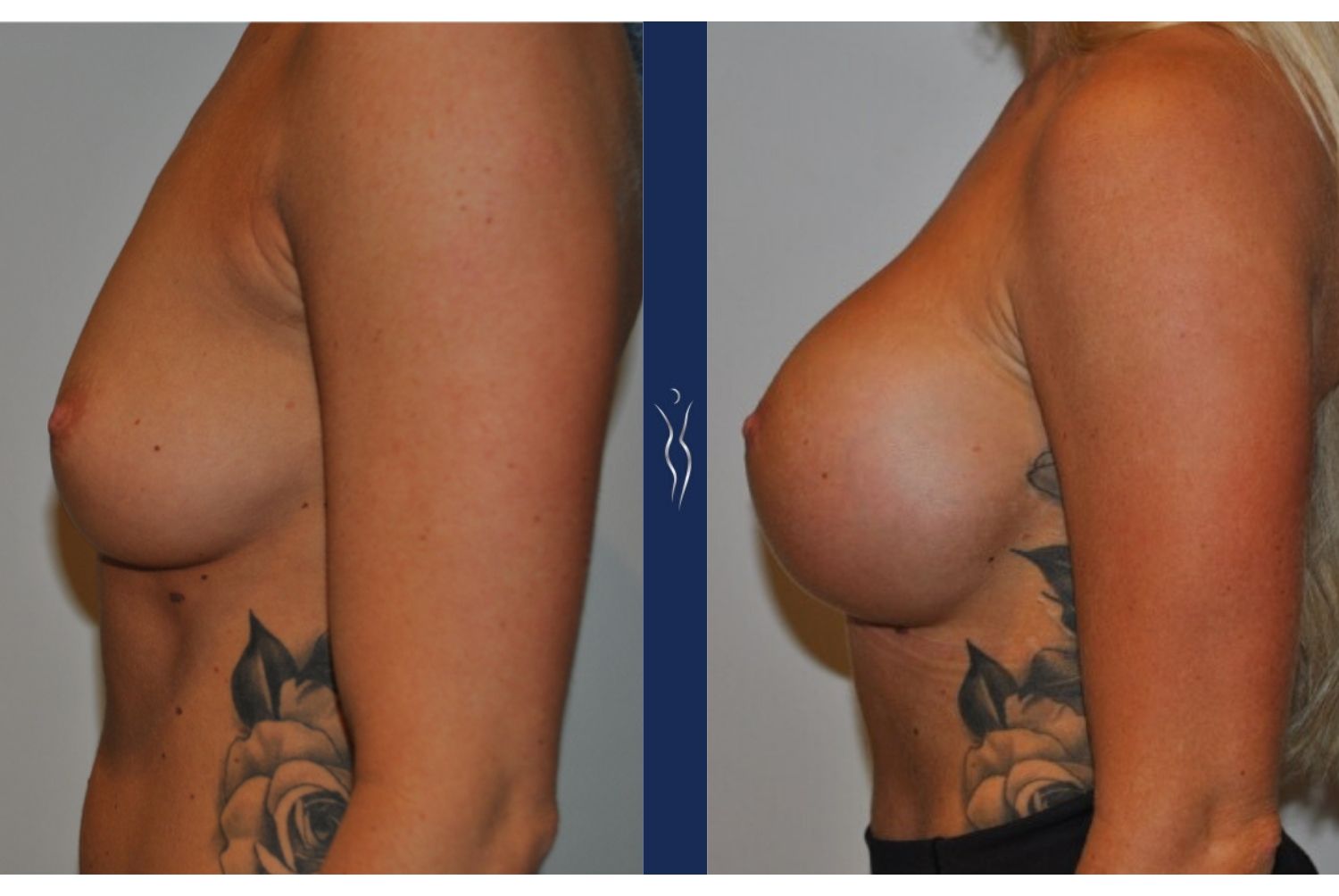 27 year old caucasian woman breast augmentation left lateral - 1