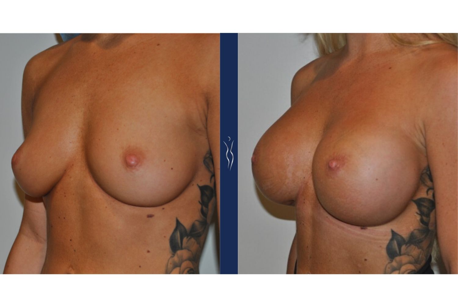 27 year old caucasian woman breast augmentation left oblique - 1