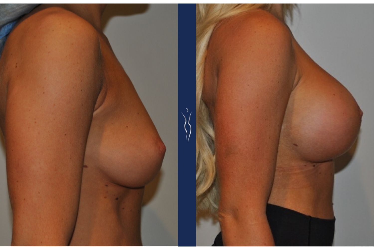 27 year old caucasian woman breast augmentation right lateral - 1