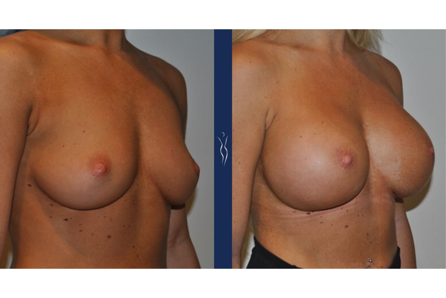 27 year old caucasian woman breast augmentation right oblique - 1