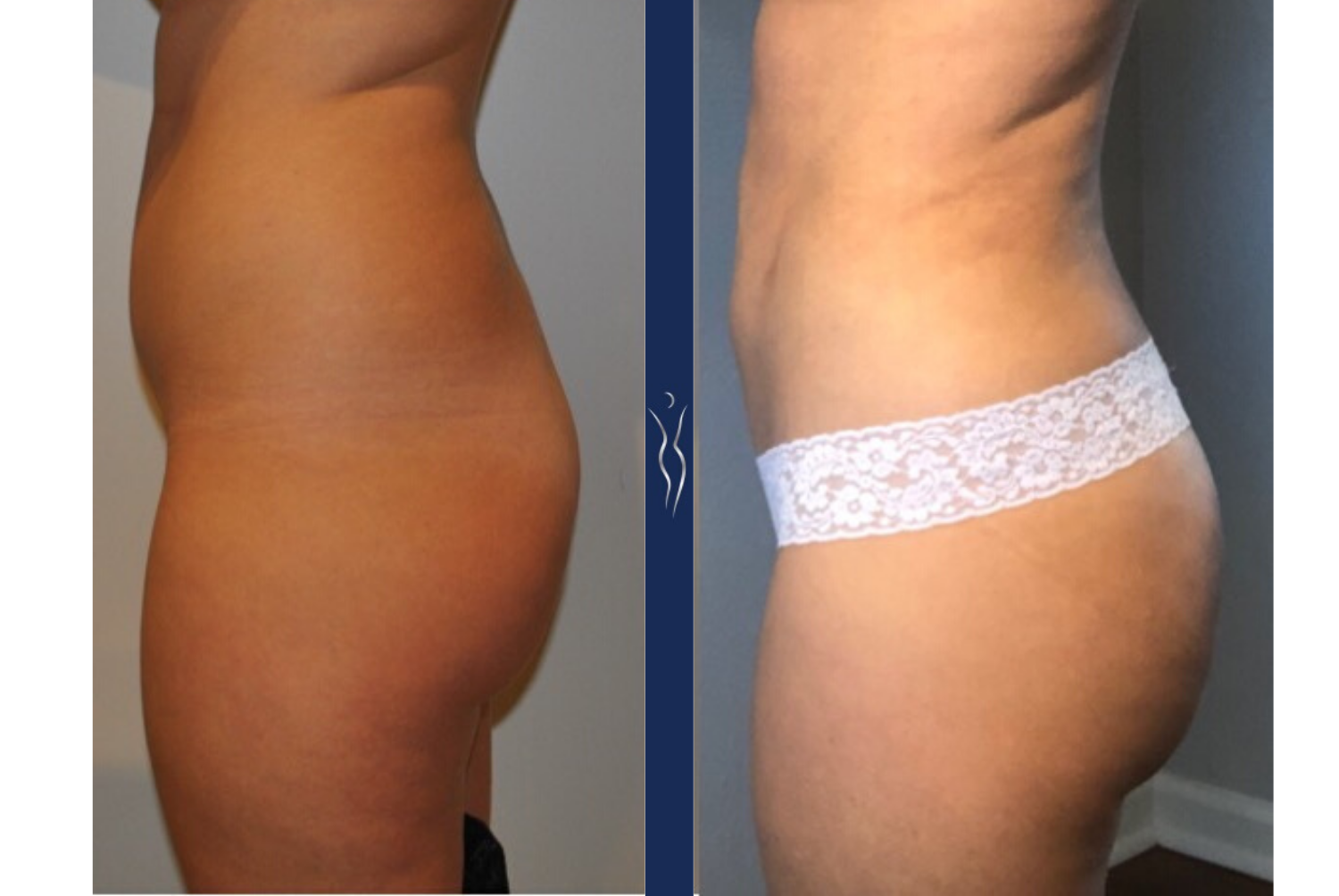 29 year old caucasian lady VASER liposuction and Renuvion with Brazilian Butt Lift left lateral