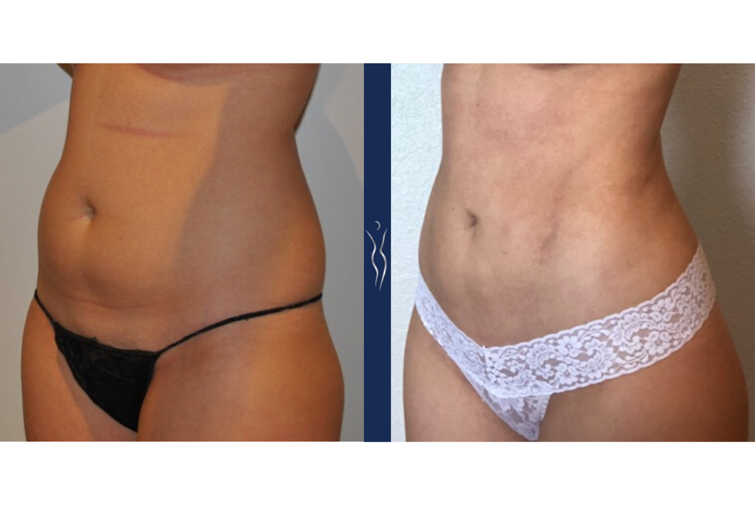 29 year old caucasian lady VASER liposuction and Renuvion with Brazilian Butt Lift left oblique
