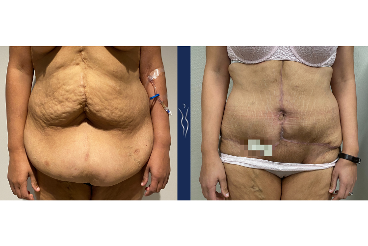 31 year old lady fleur-di-lis tummy tuck 4 months front arms down (1)-1