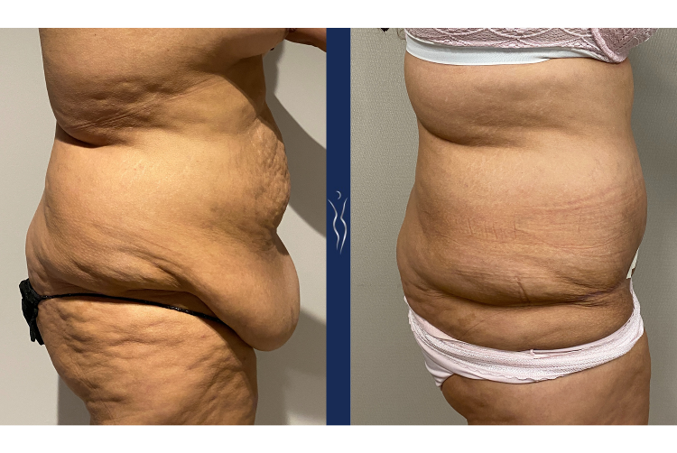 31 year old lady fleur-di-lis tummy tuck 4 months right lateral (1)-1