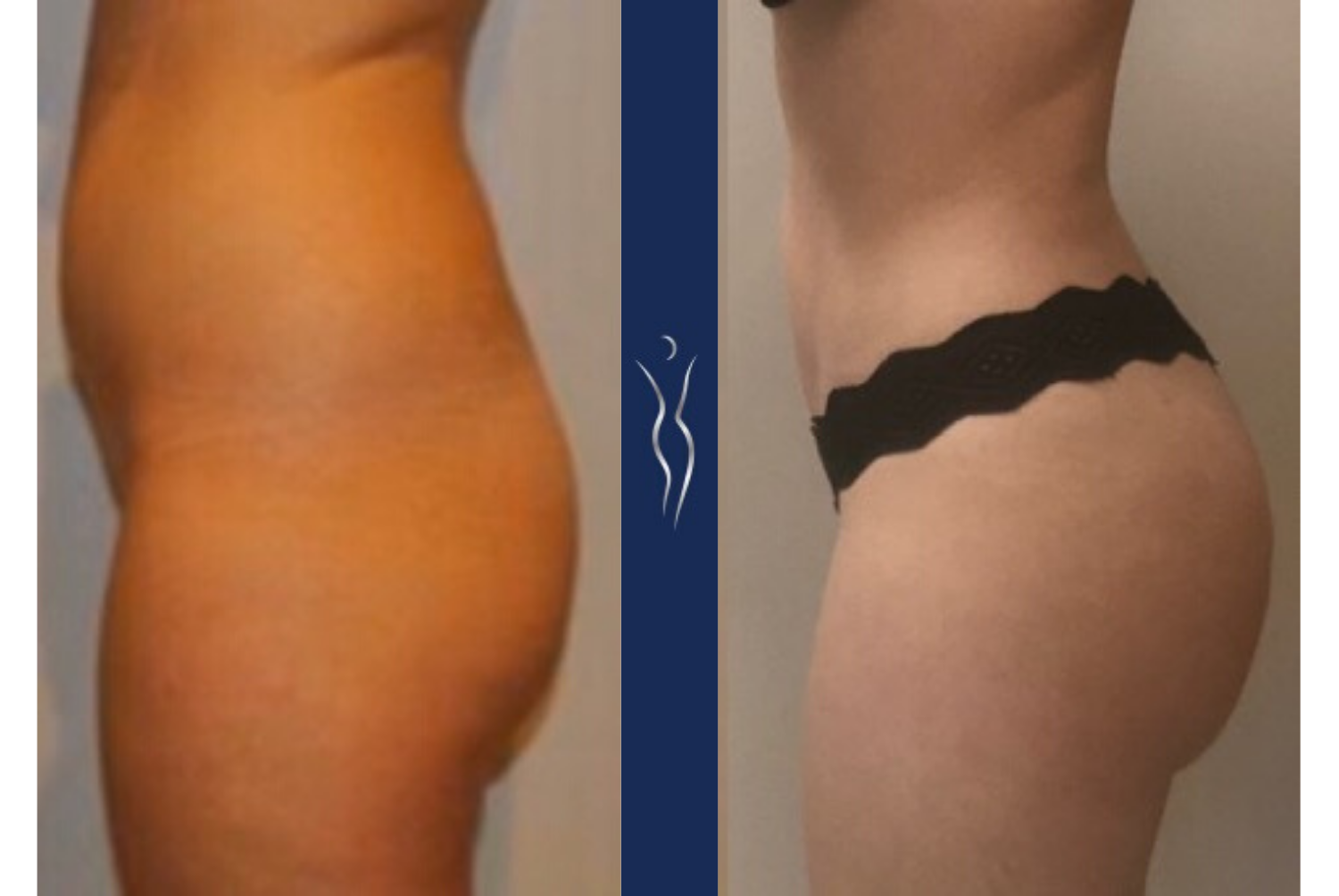 32 year old caucasian lady 3 months Brazilian Butt Lift left lateral