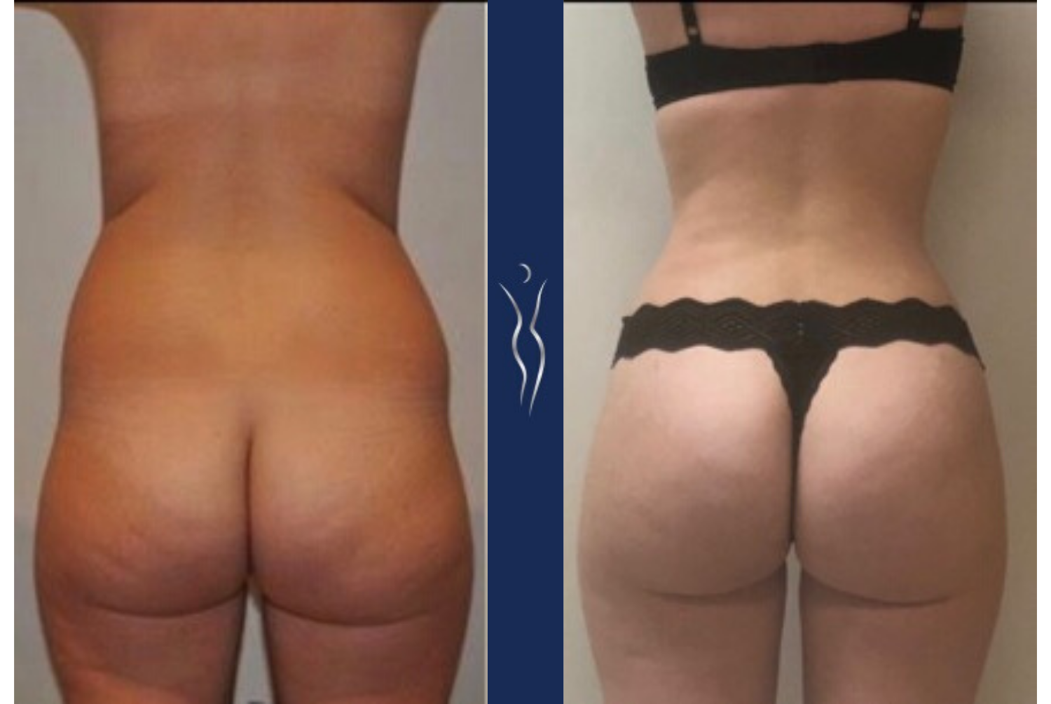 32 year old caucasian lady 3 months Brazilian Butt lift back