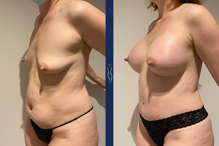 33 year old mommy makeover 3 month left oblique-3