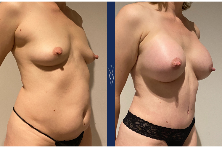 33 year old mommy makeover 3 month right oblique-2