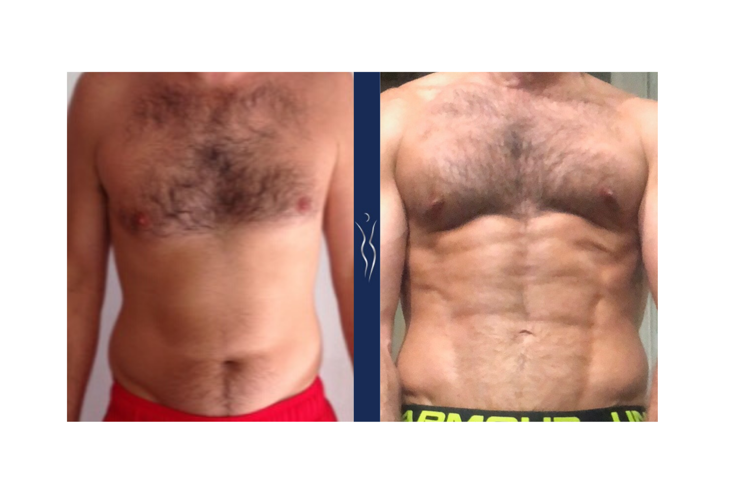 35  year old caucasian man high definition VASER core liposuction