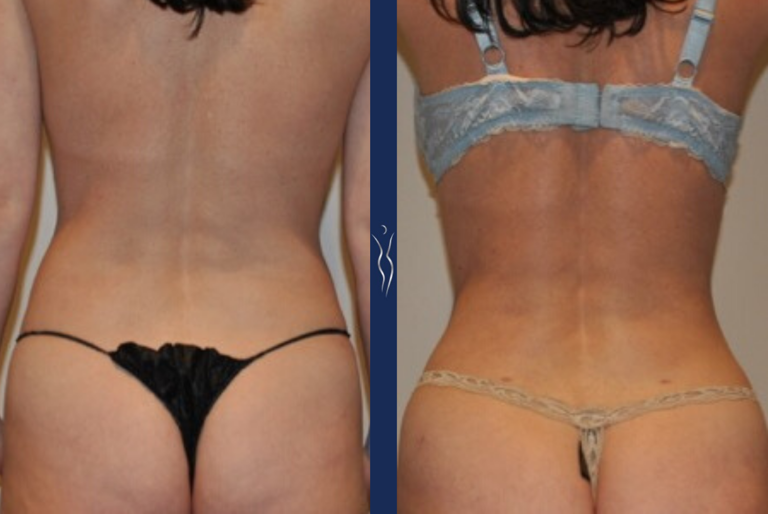 36 year old caucasian lady VASER liposuction and Renuvion back