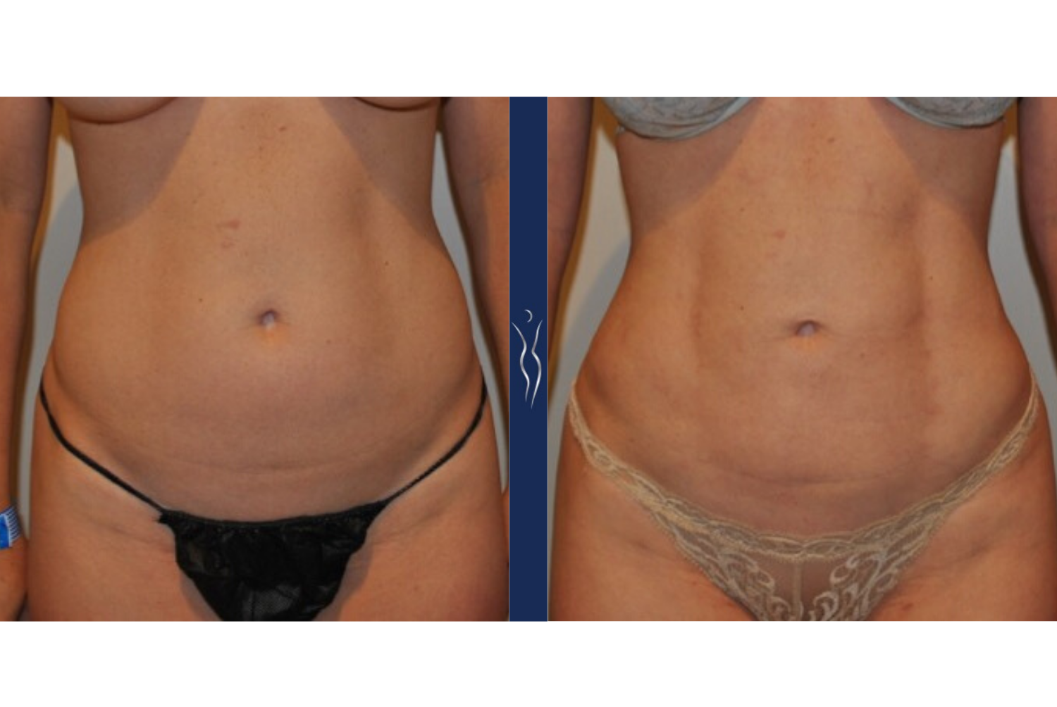 36 year old caucasian lady VASER liposuction and Renuvion front