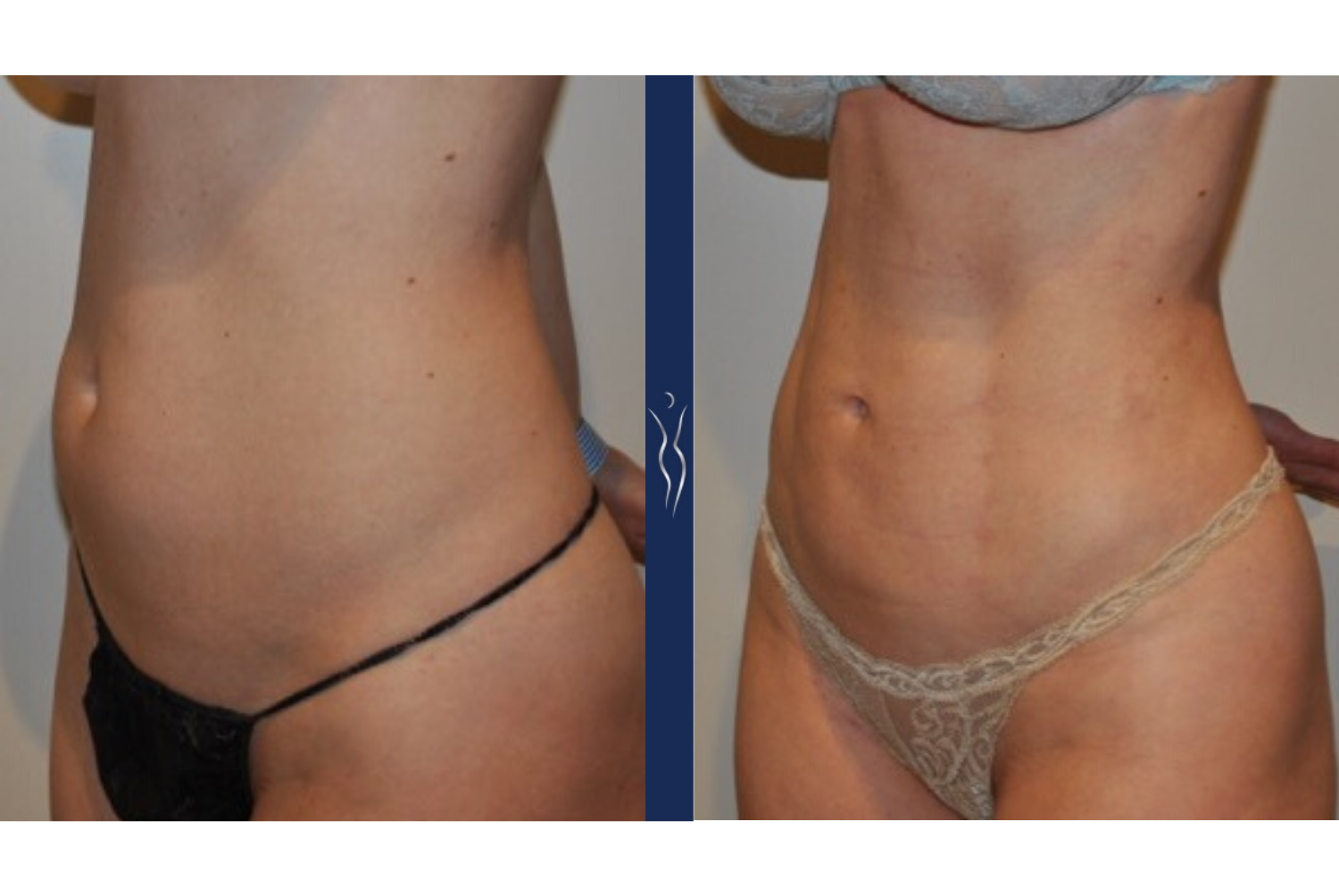 36 year old caucasian lady VASER liposuction and Renuvion left oblique