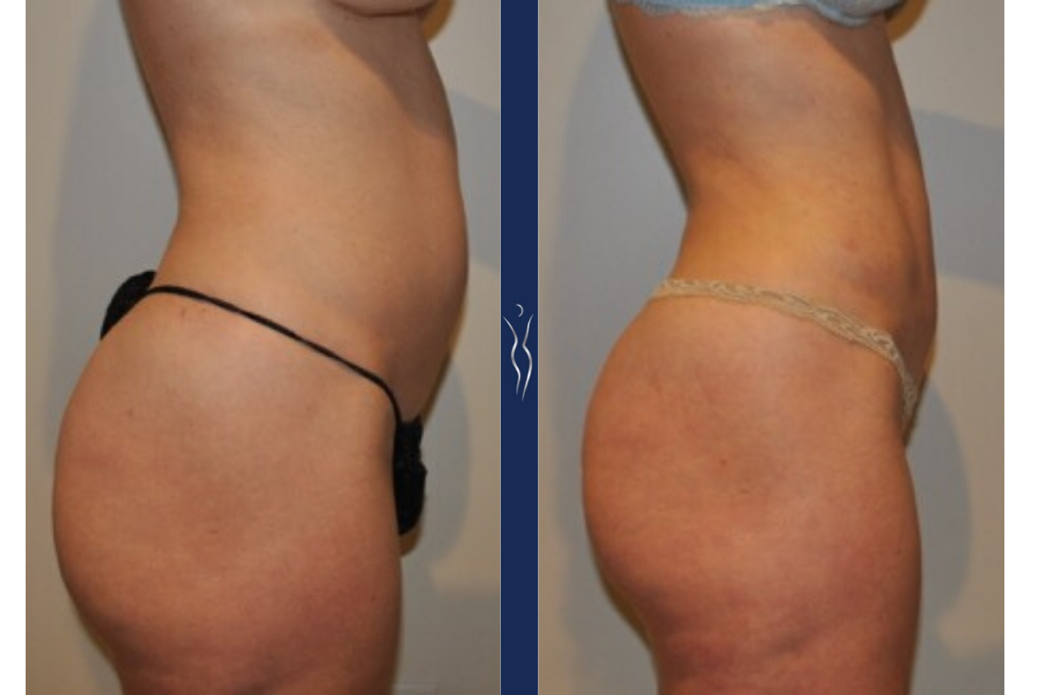 36 year old caucasian lady VASER liposuction and Renuvion right lateral-1