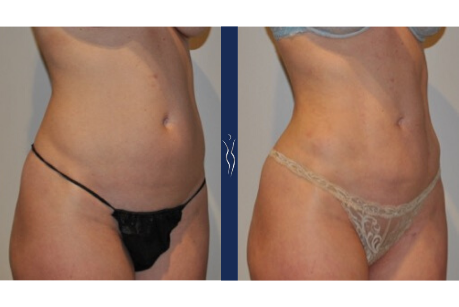 36 year old caucasian lady VASER liposuction and Renuvion right oblique