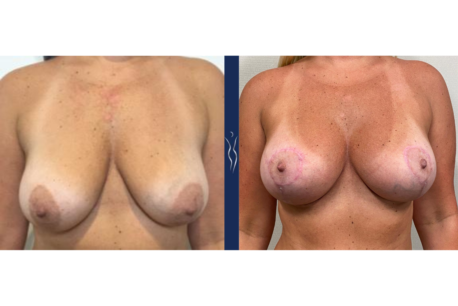 39 year old female silicone breast augmentation with lift front