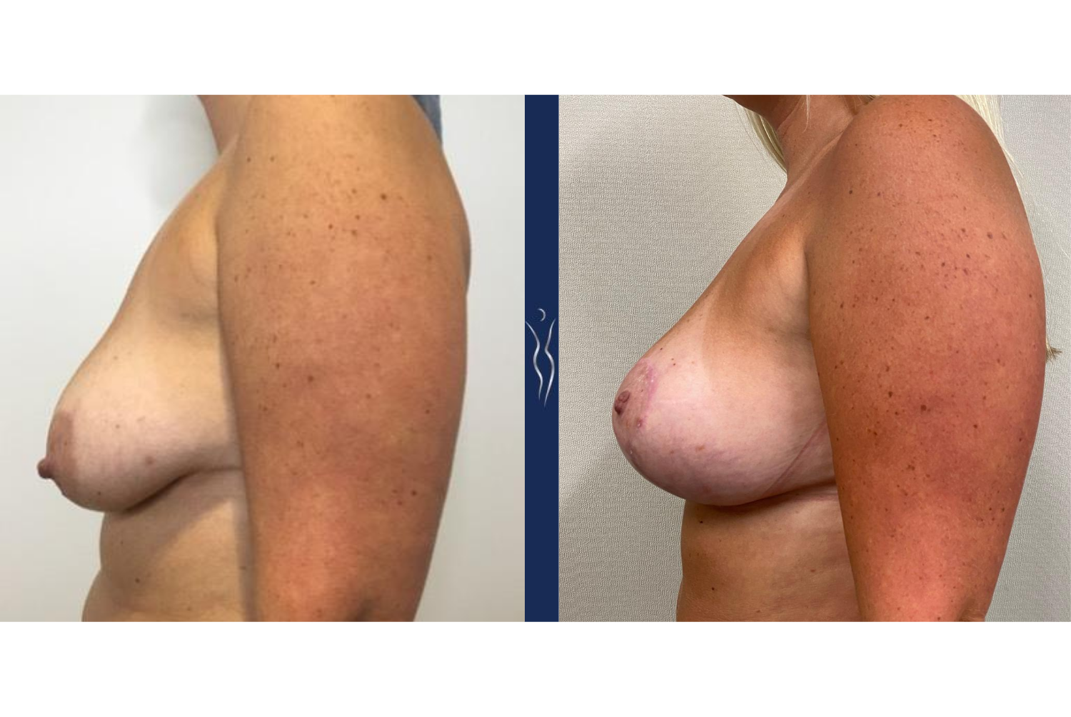 39 year old female silicone breast augmentation with lift left lateral