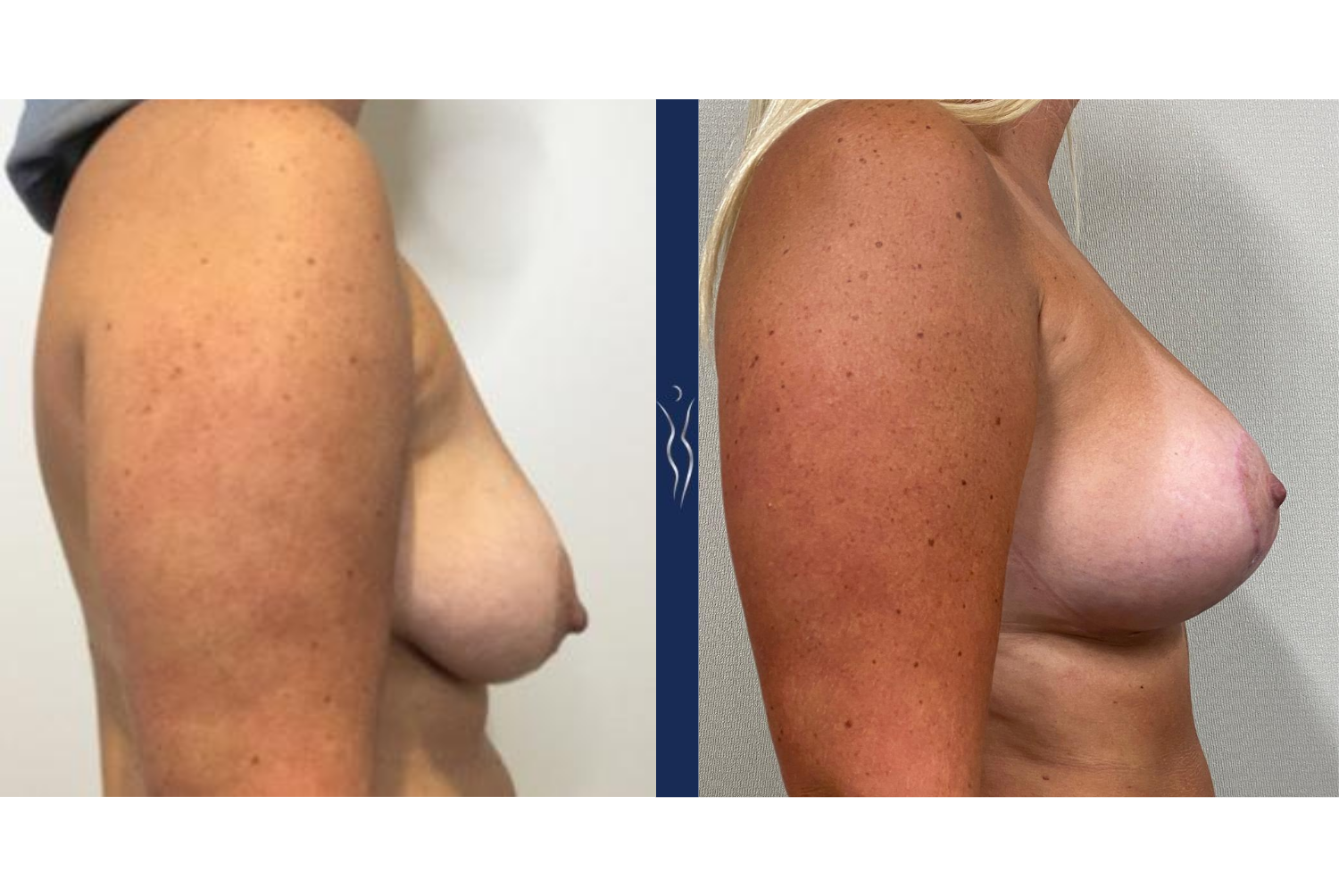39 year old female silicone breast augmentation with lift right lateral