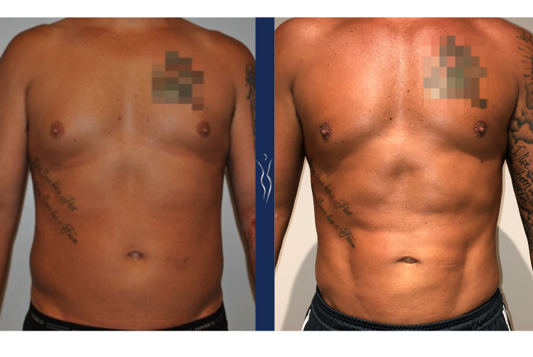43  year old caucasian man medium definition VASER core liposuction (1)-1-1