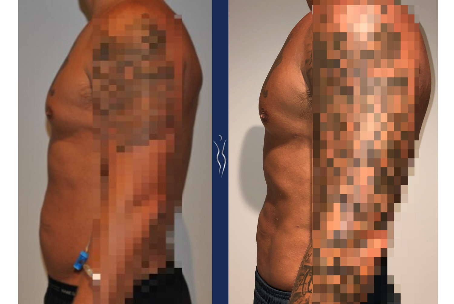 43  year old caucasian man medium definition VASER core liposuction left lateral (1)