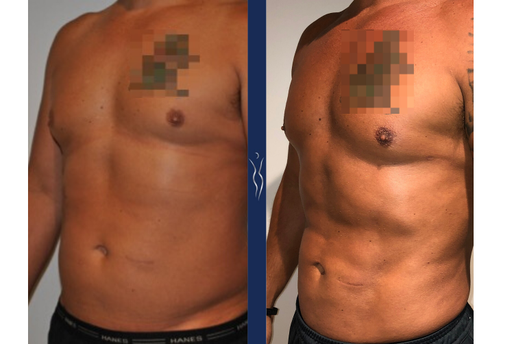 43  year old caucasian man medium definition VASER core liposuction left oblique (1)-1