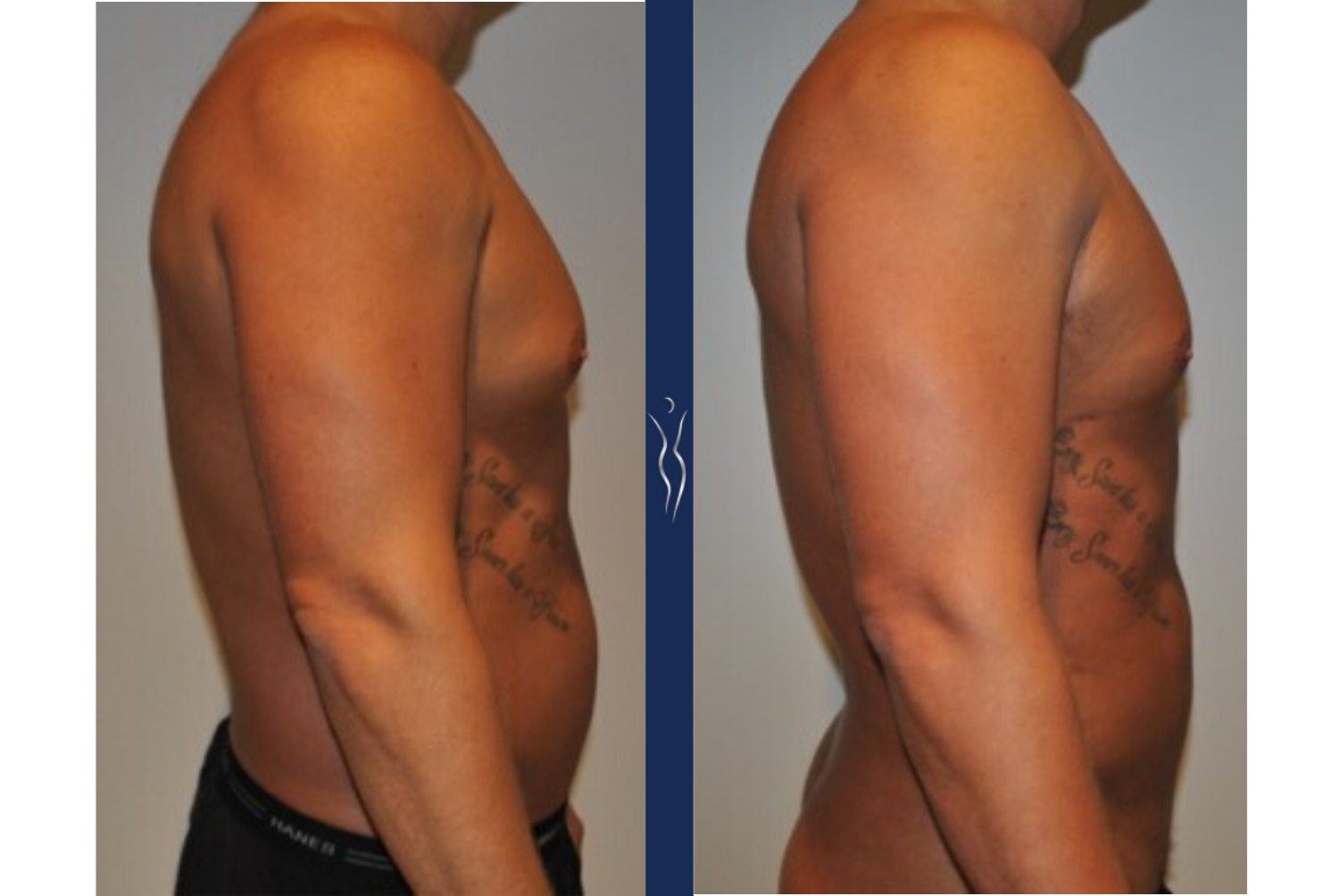 43  year old caucasian man medium definition VASER core liposuction right lateral