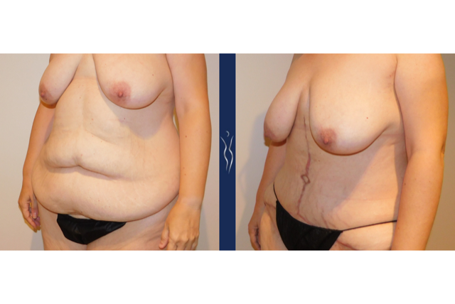 44 year old lady Fleur-di-Lis tummy tuck left oblique-1