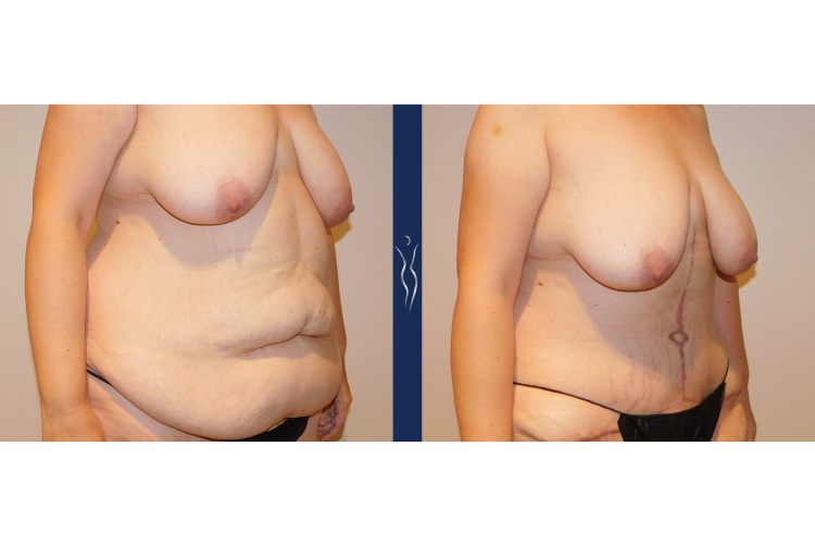 44 year old lady Fleur-di-Lis tummy tuck right oblique-2