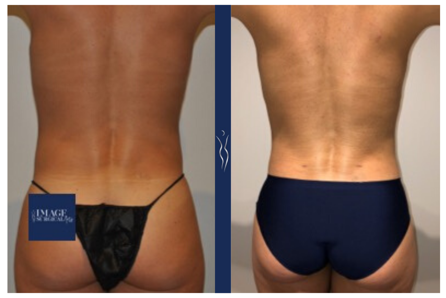 45 year old caucasian lady VASER liposuction and Renuvion back