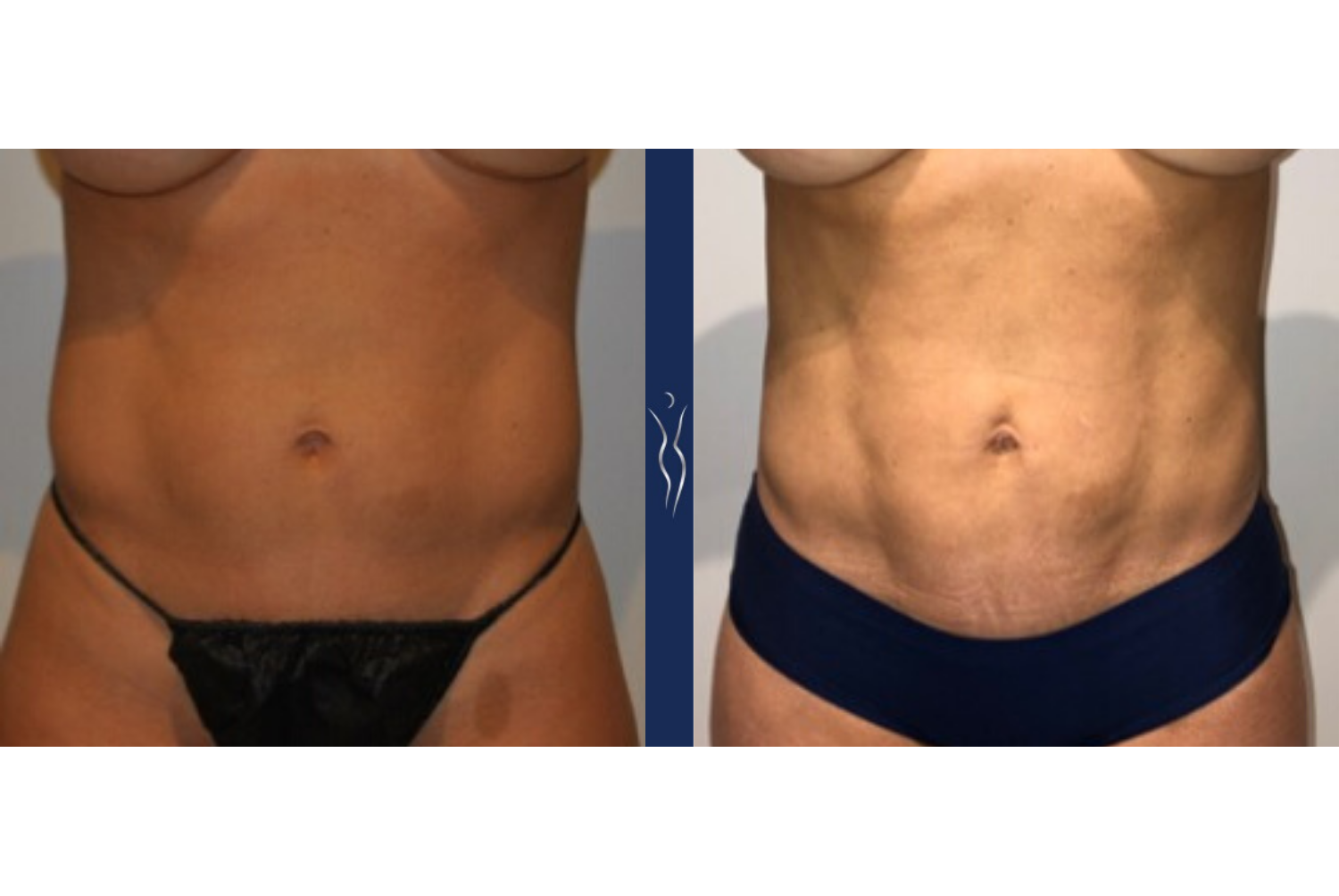 45 year old caucasian lady VASER liposuction and Renuvion front