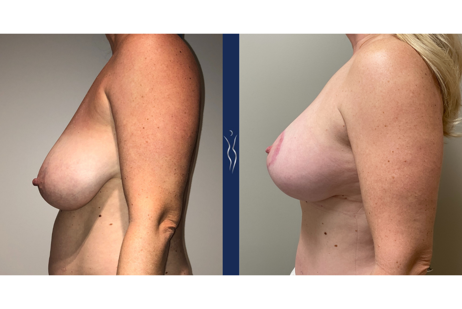 46 year old lady breast augmentation with lift left lateral 3 months