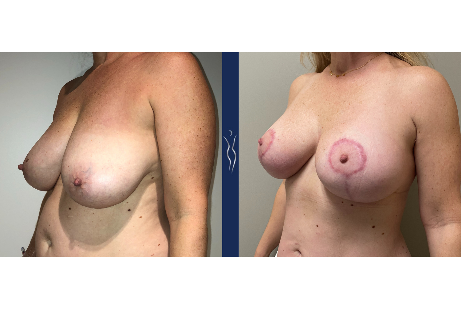 46 year old lady breast augmentation with lift left oblique 3 months